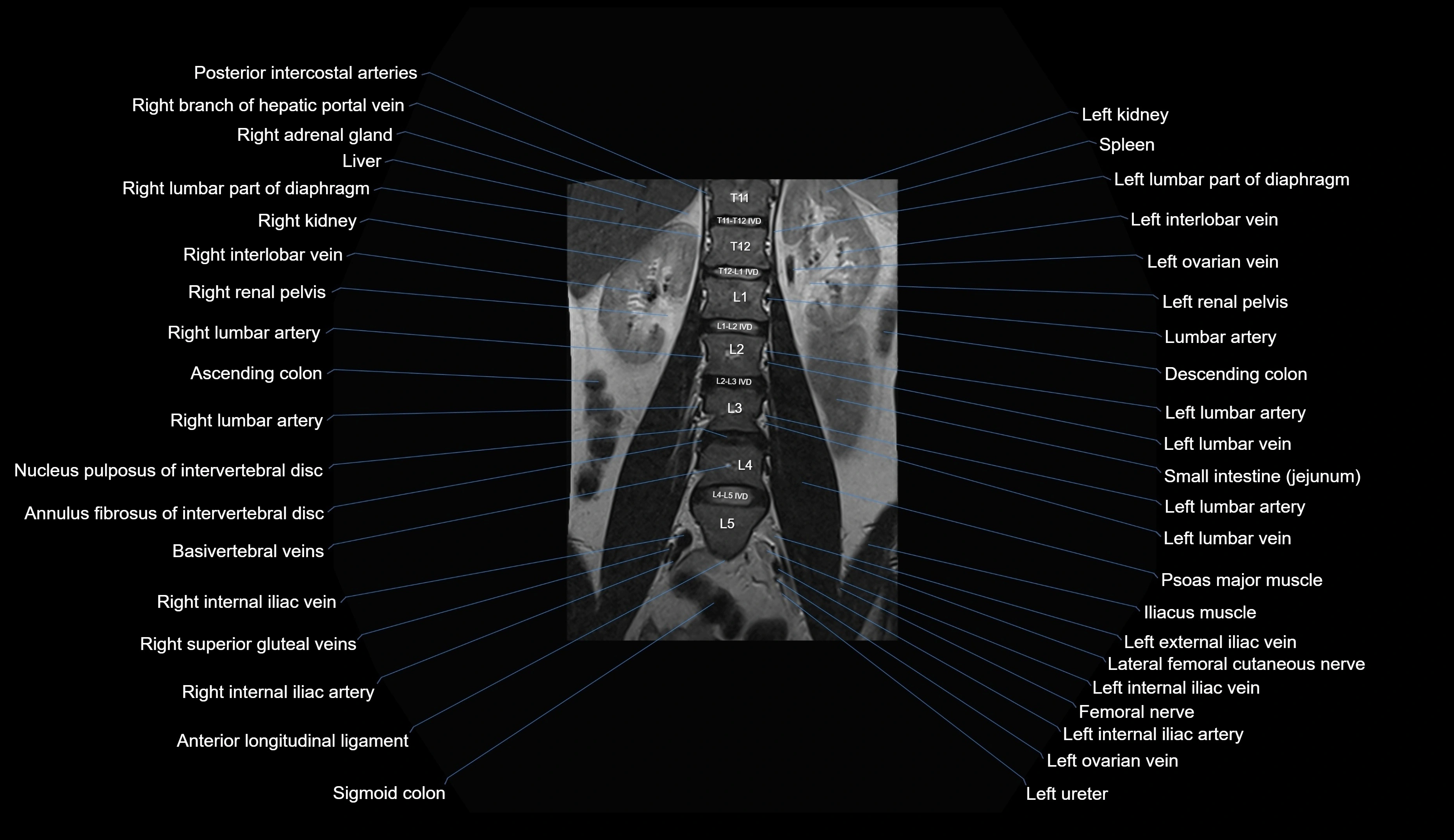 MRI lumbar spine coronal cross sectional anatomy 3T radiology  image-img-00001-00014.webp